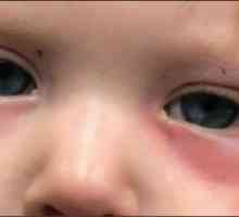 Зачервяване под очите на дете: причини и лечение