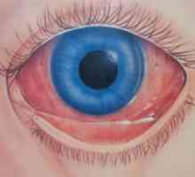 Протеини на червени очи: причини, ефекти и методи на лечение. Защо са червените катерици в дете или…