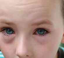 Червени очи при децата - възможност да се обърнете към офталмолог