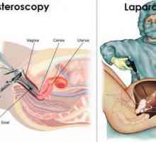 Лапароскопия и хистероскопия: показания, прегледи, което е по-добре