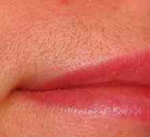 Лазерна епилация на горната устна: ефективна процедура в борбата с отегчени косми