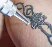 Лазерно отстраняване на татуировки - описание на процедурата, функции и отзиви