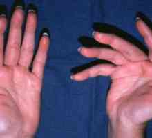 Лечение на артрит на пръстите