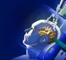 Лечение на мозъчни тумори в Израел - иновативни методи