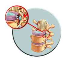 Лечение на гръбначния стълб: основни техники