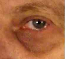 Лечение на натъртвания под очни фоликули и медикаментозни методи