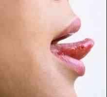 Лечение на стоматит на езика с различни форми на заболяването