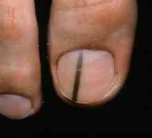Меланом на ноктите: признаци и лечение