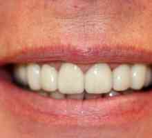 Металокерамични зъби. Протетична стоматология: керамика