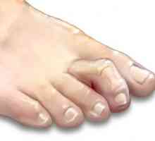 Чук-образни пръсти на крака: симптоми, причини, превенция и лечение функции