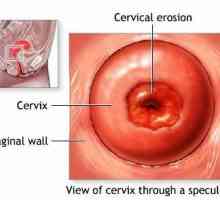 Възможно ли е да забременеете с ерозия на шийката на матката: експертни мнения и важни факти