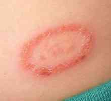 На кожата петно ​​с червен ръб: възможни причини и характеристики на лечението
