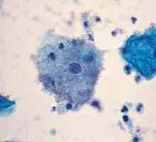 Нарушаване на микрофлората на влагалището: причини и симптоми