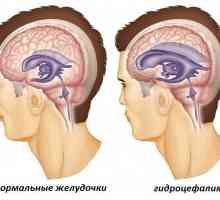 Външен хидроцефалит на мозъка при възрастни: признаци и лечение