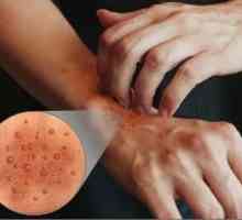 Невродермитит върху ръцете: етиология, клиника, характеристики на лечението
