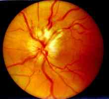 Очен неврит: причини, симптоми, диагноза и функции на лечение
