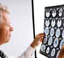 Неврология: мозъчни симптоми на увреждане на мозъка