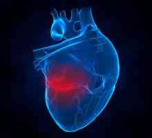 Разширен сърдечен пристъп: последствия, шанс за оцеляване, рехабилитация при мъже и жени