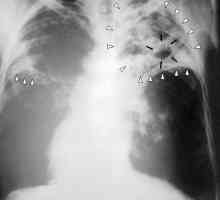 Дали инкубационният период на туберкулозата е опасен?