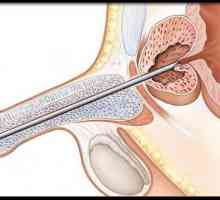 Операция на аденом на простатата, диагноза и лечение