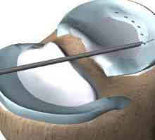 Работа по колянната става, при менискуса: прегледи. Рехабилитация след операция на менискуса на…