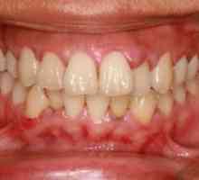 Венците се набъбват, но зъбът не боли - какво да правим или правим? Причини за подуване на венците…
