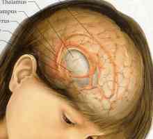 Мозъчен тумор: симптоми на ранен етап. Първите признаци на мозъчен тумор
