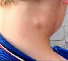Тумор на шията: причини, симптоми, сортове и характеристики на лечението