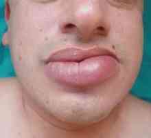 Пухкава устна: четири причини за неразположение