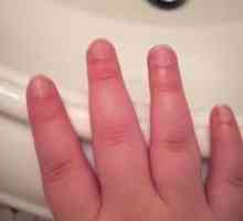 Пухкави пръсти на ръцете: причини, диагноза, лечение. Какво да направите, ако ставите на пръстите…