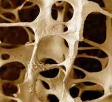 Остеопорозата. Каква е тази патология?
