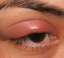 От какво се появява ечемикът на очите ви? Причини и лечение