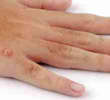 Какво причинява брадавици на ръцете ви? Защо брадавиците се появяват на пръстите на децата?