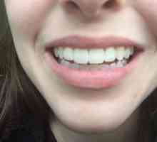 Избелване на зъби Magic White: прегледи на зъболекари