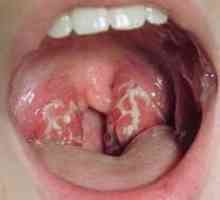 Къде е стафилококът в гърлото? Симптомите на инфекцията