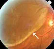Отделяне на ретината, хирургия: прегледи. Как се извършва операцията, възстановяване?