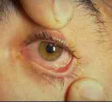 Изгаряне на очите: първа помощ и лечение