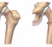Фрактура на бедрената кост: лечение, хирургия, време за възстановяване