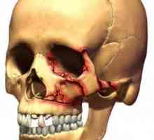 Фрактури на черепа: видове, симптоми, лечение и последици