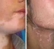 Подмяна на кожата: Характеристики на хирургията