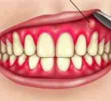 Периостит на зъба: видове, причини, симптоми и лечение