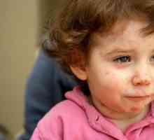 Хранителна алергия при деца: симптоми, лечение и последствия