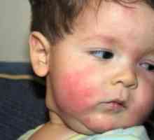 Хранителни алергии при дете: какво да правите?