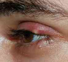 Писак на окото: симптоми, лечение, профилактика