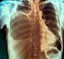Pleurisy с рак на белите дробове: описание, причини, симптоми и лечение