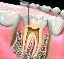 Пълнене на зъбни канали: методи и материали