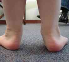 Ploskovolgusnye крака на детето. Методи на лечение