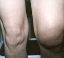 Защо коляното е подуто и болезнено? Причини и лечение