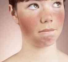 Защо лицето се превръща в червено: причините и начините на лечение