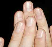 Защо ноктите изглеждат бели петна и какво могат да кажат?